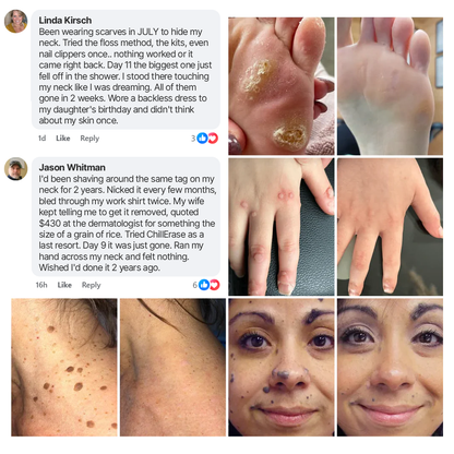 Timilk ChillErase® Bump Renewal Spray